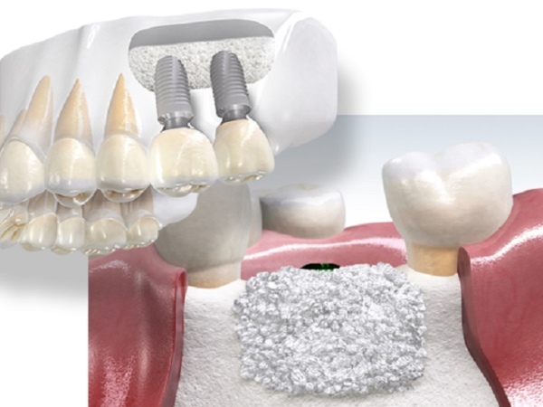 Nha Khoa Quốc Tế Sài Gòn Ghép xương trước khi cấy implant giúp trụ tích hợp vững chắc hơn