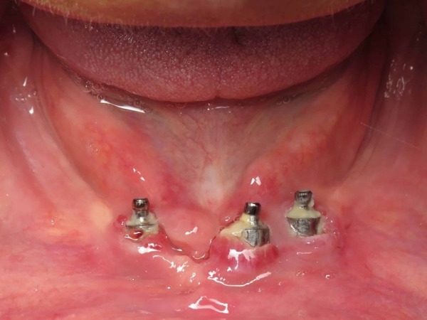 Nha Khoa Quốc Tế Sài Gòn Trụ implant bị nhiễm trùng dẫn đến tình trạng mất răng