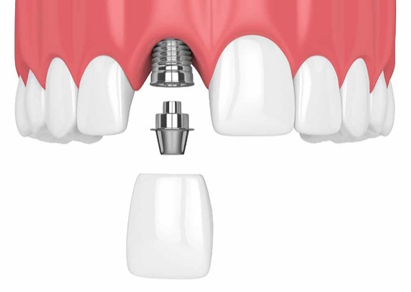 Nha Khoa Quốc Tế Sài Gòn Bác sĩ tiến hành cấy ghép trụ Implant tại vị trí xương hàm nơi răng cửa đã mất