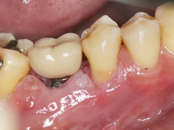 Nha Khoa Quốc Tế Sài Gòn Tình trạng nhiễm trùng nhẹ xung quanh trụ Implant