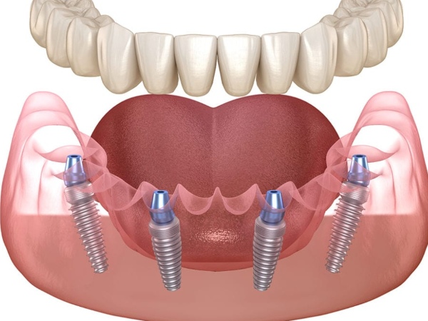 Nha Khoa Quốc Tế Sài Gòn Hình ảnh trụ Implant đã được cấy ghép cho bệnh nhân