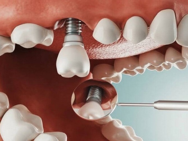 Nha Khoa Quốc Tế Sài Gòn Nên vệ sinh răng miệng đúng cách sau khi nhiễm trùng implant