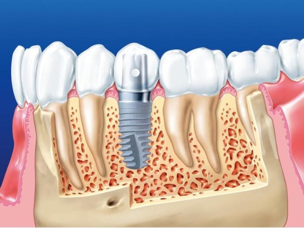 Nha Khoa Quốc Tế Sài Gòn Trồng Implant răng hàm thường chỉ đau nhẹ