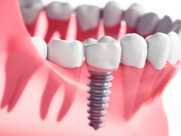 Nha Khoa Quốc Tế Sài Gòn Trụ Implant đã được tích hợp sau quá trình ghép xương