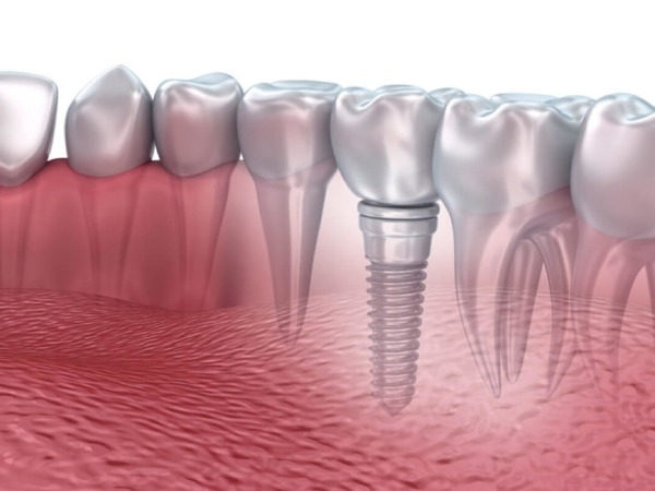 Nha Khoa Quốc Tế Sài Gòn Tình trạng tiêu xương không xảy ra khi cấy trụ Implant