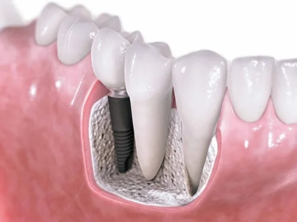 Nha Khoa Quốc Tế Sài Gòn Từ 7 đến 10 ngày sẽ đỡ đau và sưng sau khi ghép xương