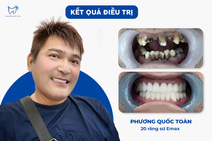 Nha Khoa Quốc Tế Sài Gòn Tình trạng răng hỏng nặng của anh Vương Quốc Toàn