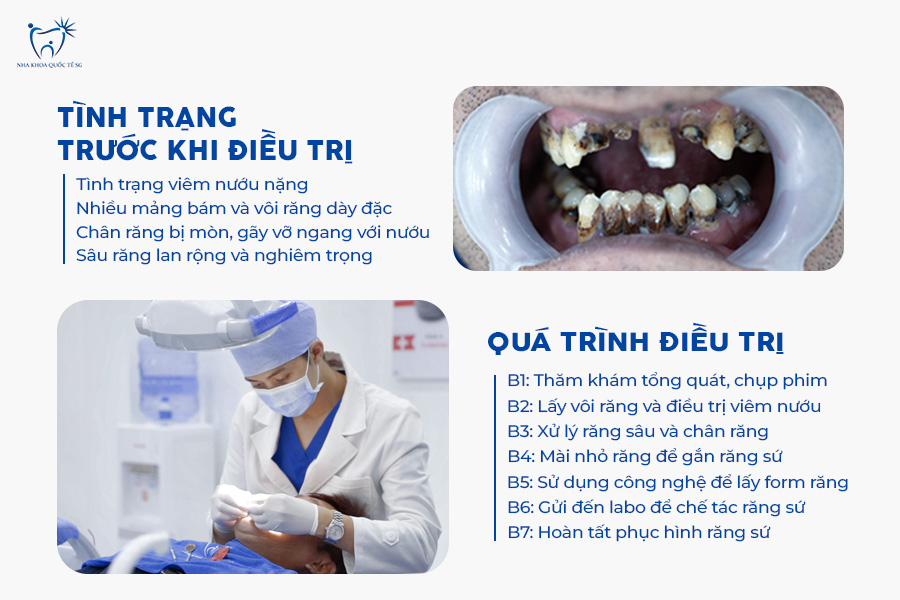 Nha Khoa Quốc Tế Sài Gòn Before - After của anh Vương Quốc Toàn sau khi làm răng sứ