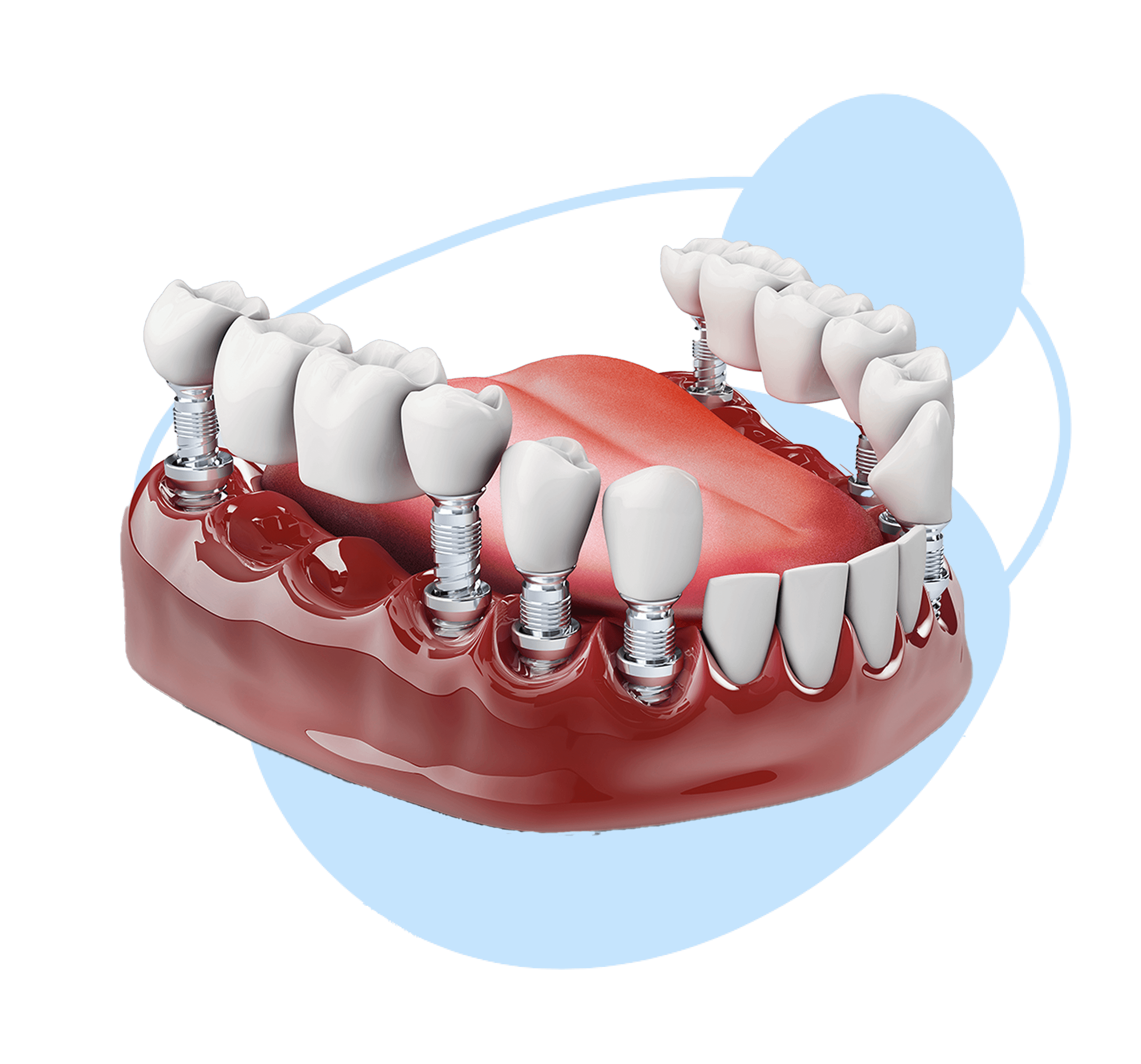 Mô hình cấy ghép răng Implant bằng phương pháp toàn hàm