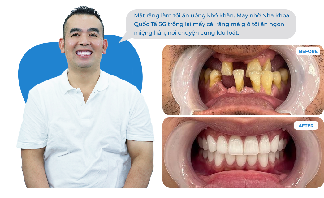 Dental Implant Case 1