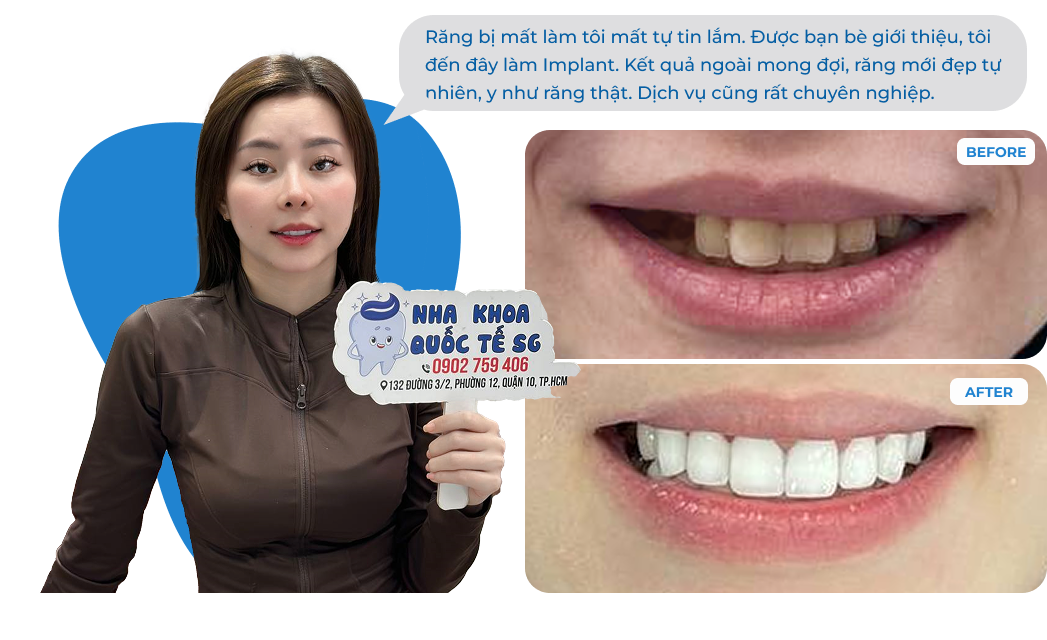 Dental Implant Case 2