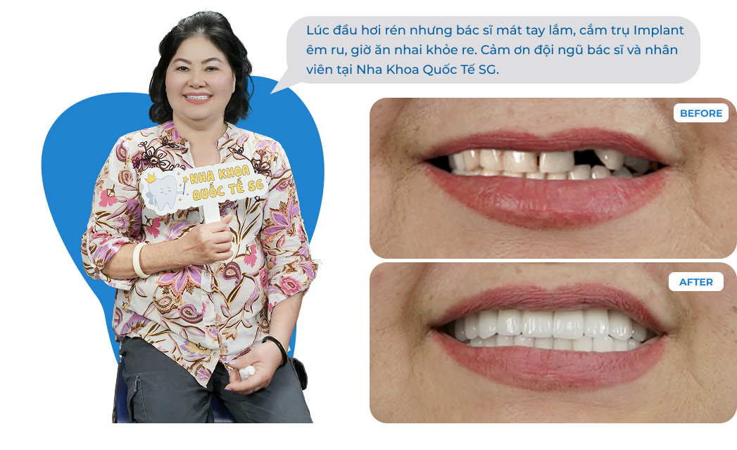 Dental Implant Case 3