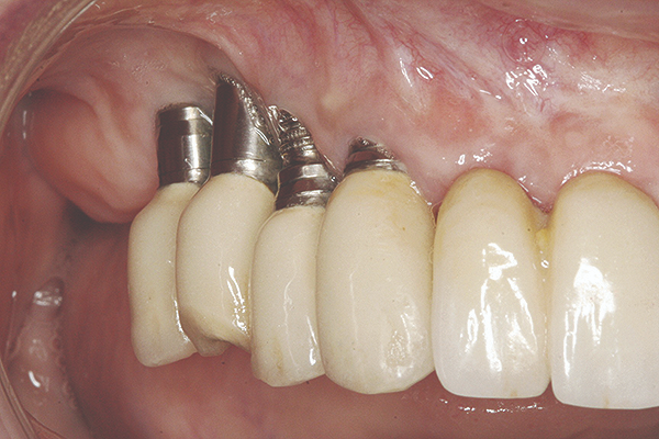 Nha Khoa Quốc Tế Sài Gòn Đào thải trụ Implant