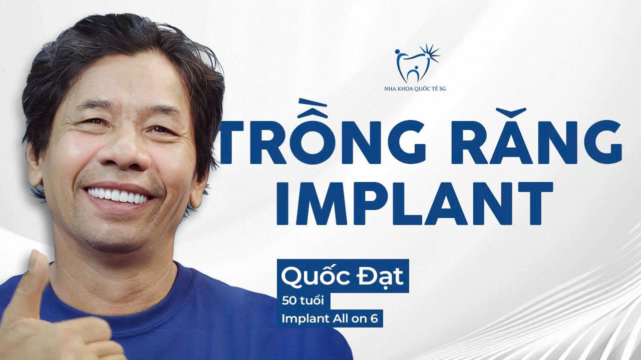 Quốc Đạt trồng răng Implant All On 6