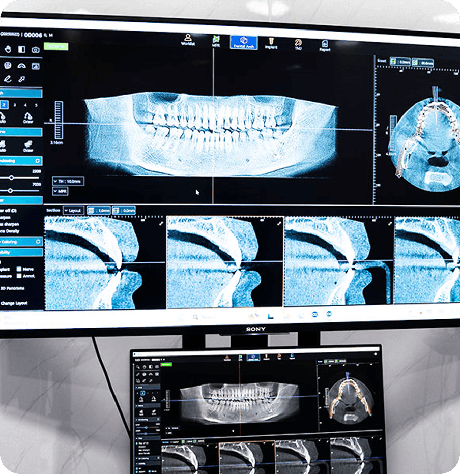 chụp X-quang kiểm tra tình trạng răng