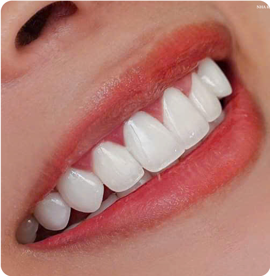 Phục hình răng sứ trên Implant
