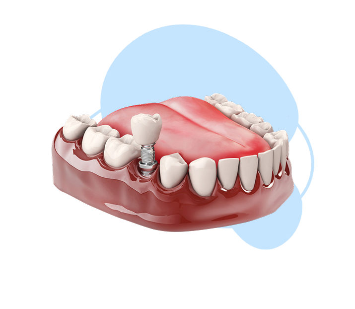 Mô hình cấy ghép răng implant
