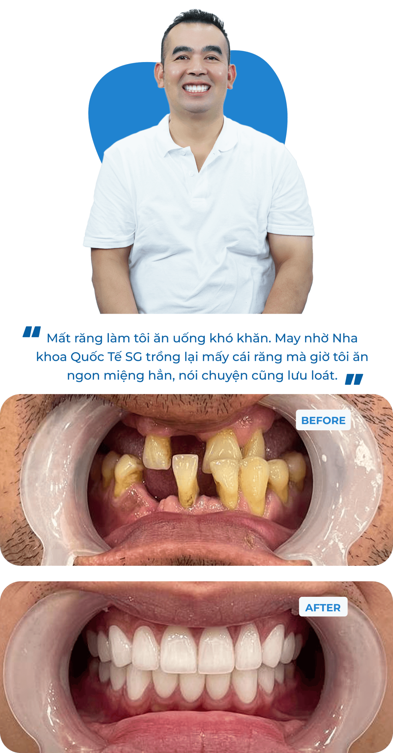 Dental Implant Case 1