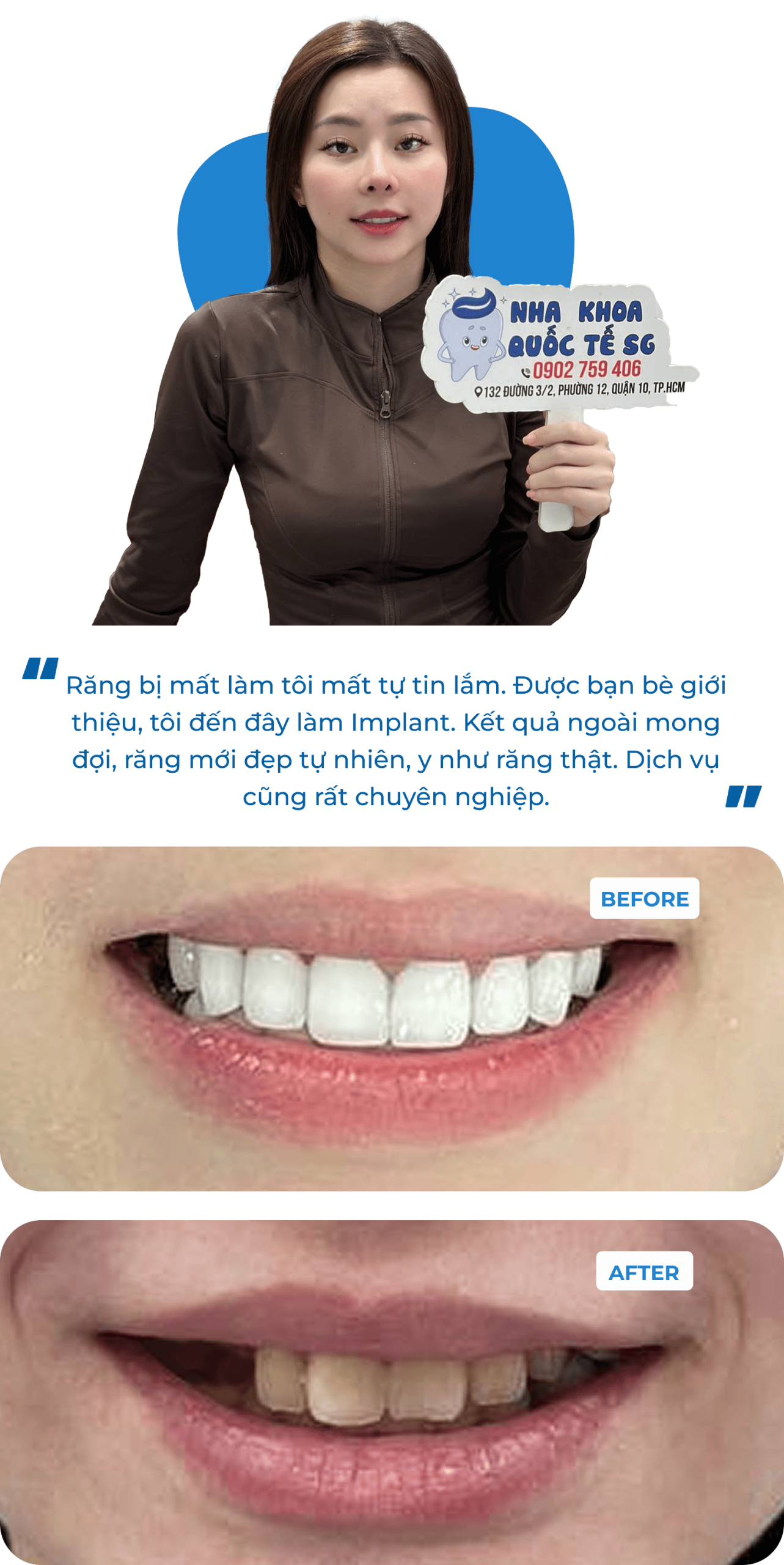 Dental Implant Case 2