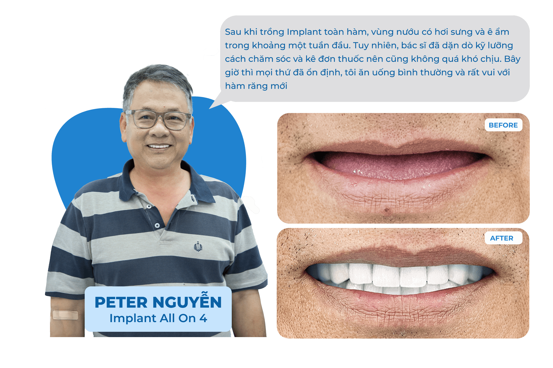 Dental Implant Case 1