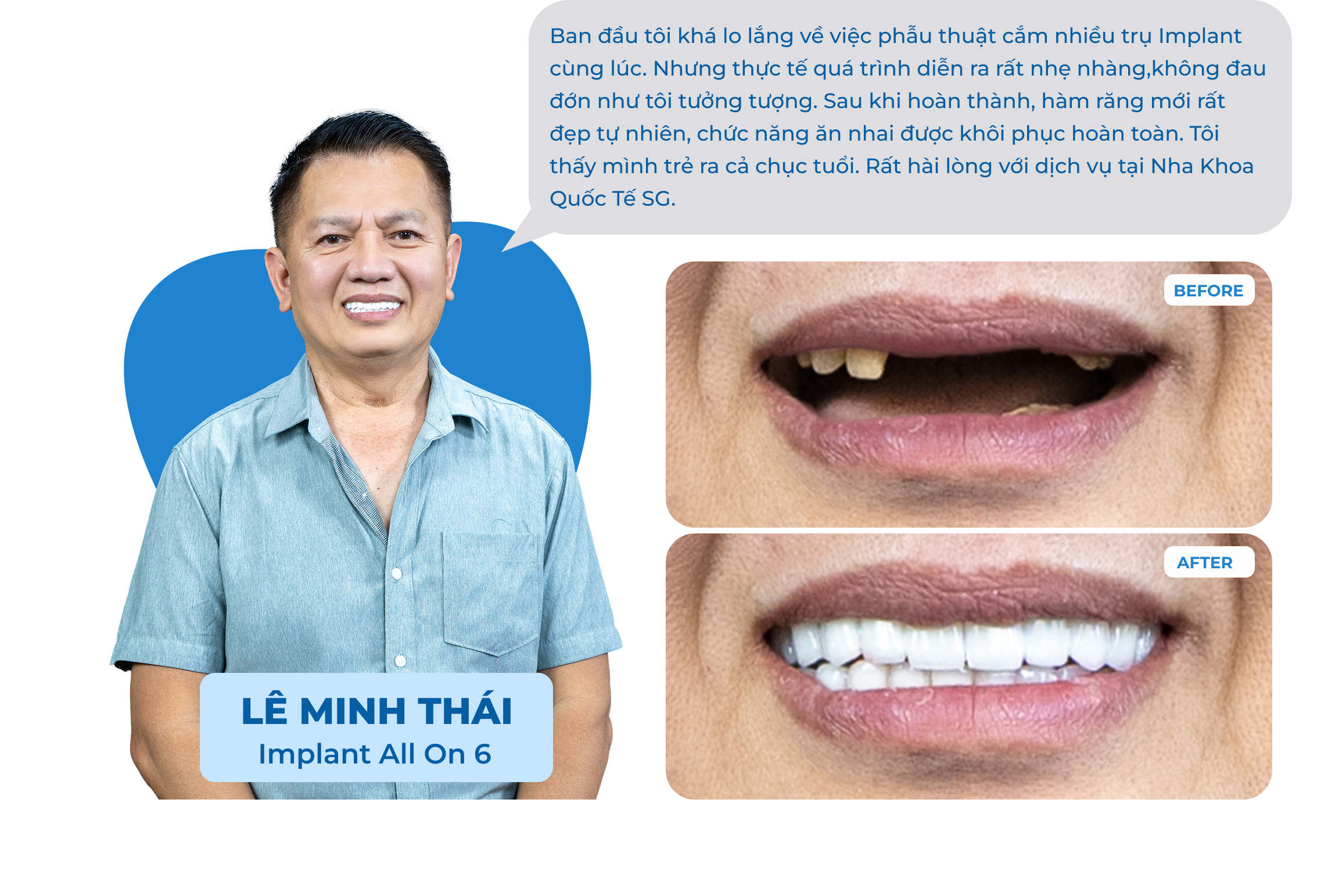 Dental Implant Case 2