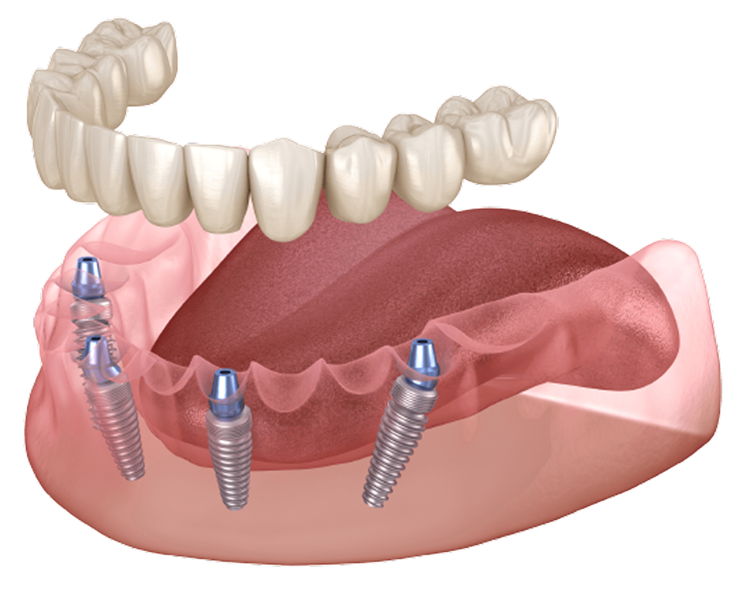 Kỹ thuật cấy ghép Implant All-on-4