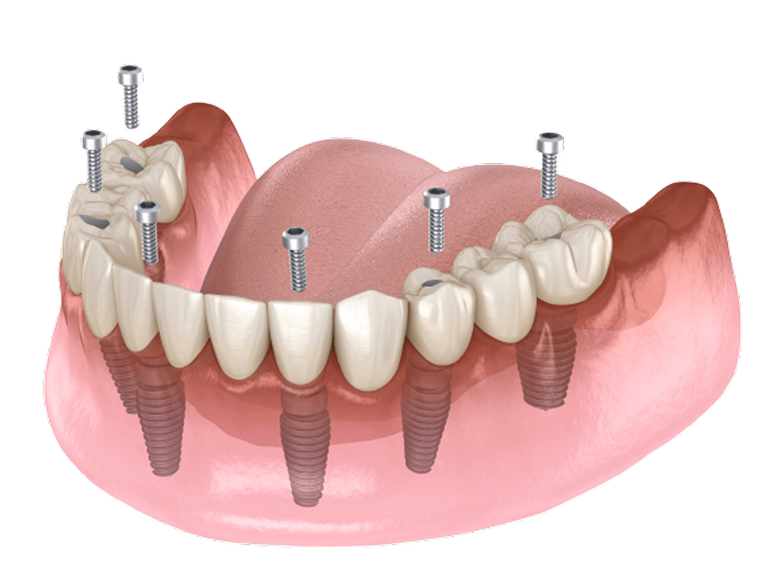 Kỹ thuật cấy ghép Implant All-on-6