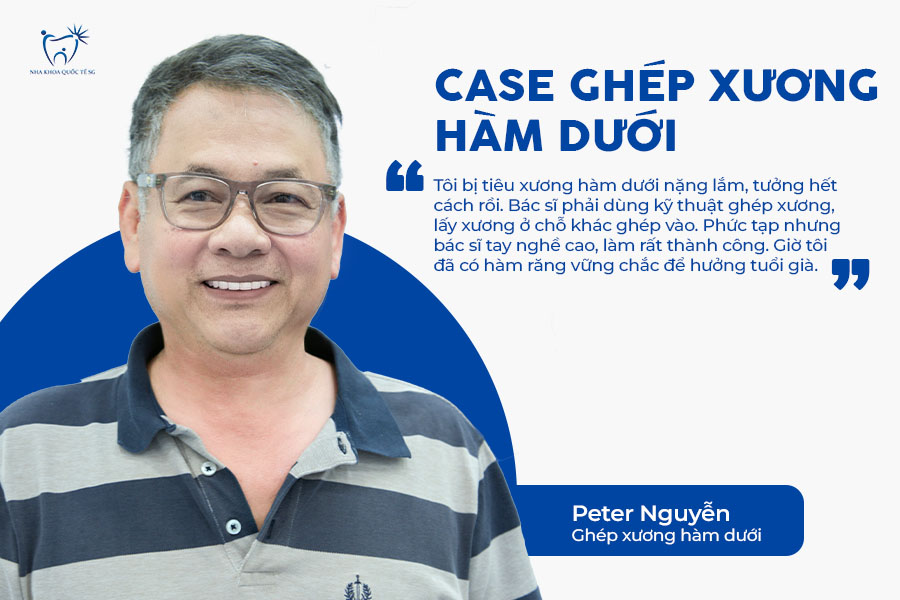 Nha Khoa Quốc Tế Sài Gòn Trải nghiệm thực tế của Anh Peter Nguyễn khi ghép xương để trồng Implant