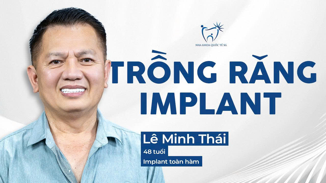 Lê Anh Thái cấy ghép Implant toàn hàm