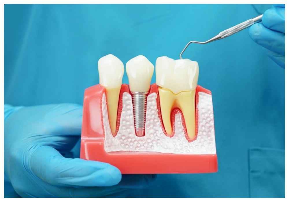 Nha Khoa Quốc Tế Sài Gòn Một vài lưu ý quan trọng sau trồng răng Implant