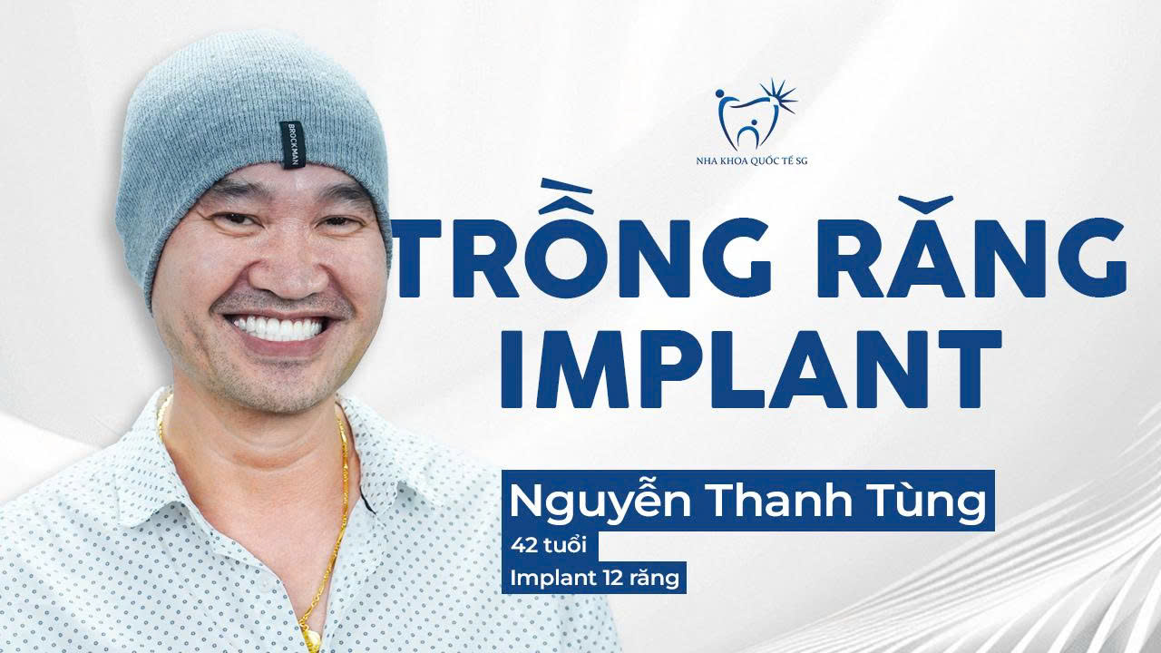 Nguyễn Thanh Tùng trồng 12 răng Implant