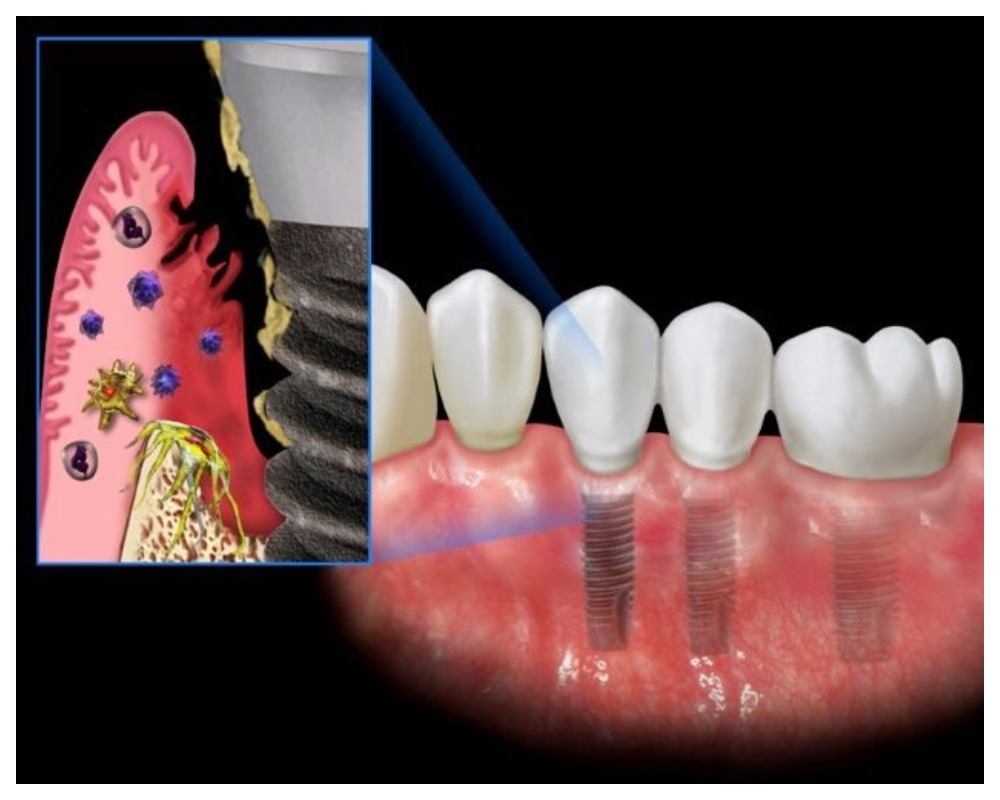 Nha Khoa Quốc Tế Sài Gòn Nhiễm trùng quanh vị trí cấy ghép implant