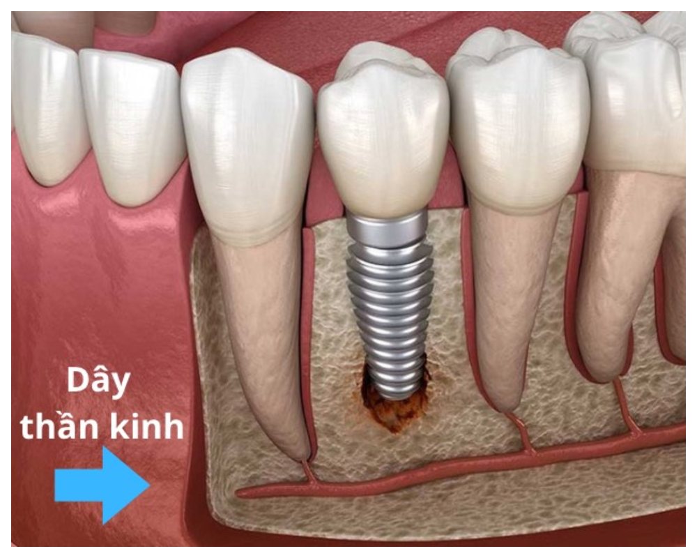 Nha Khoa Quốc Tế Sài Gòn Đặt trụ Implant sai cách gây tổn thương dây thần kinh