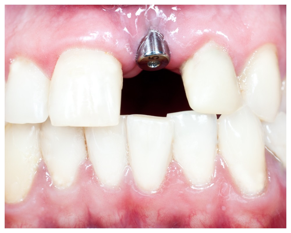 Nha Khoa Quốc Tế Sài Gòn Trụ implant bị gãy, lỏng lẻo sau thời gian cấy ghép