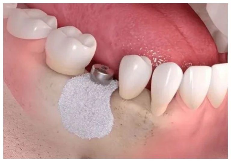 Tiêu xương hàm xung quanh Implant