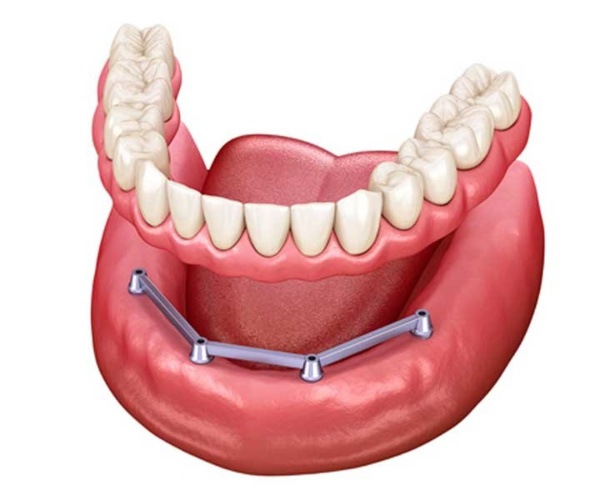 Nha Khoa Quốc Tế Sài Gòn Phương pháp hàm tháo lắp trên Implant cấy ghép 4 trụ Implant