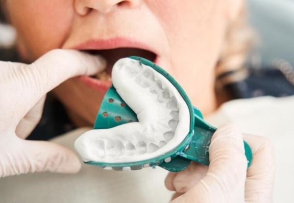 Nha Khoa Quốc Tế Sài Gòn Lấy dấu khay mở Implant sát sẽ đảm bảo khớp chính xác với trụ đã cấy