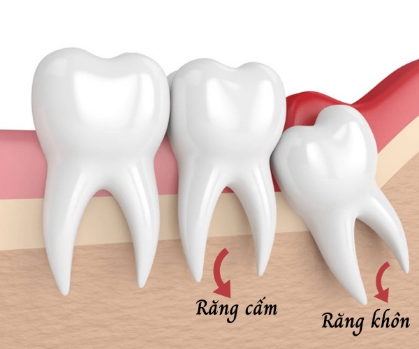 Nha Khoa Quốc Tế Sài Gòn Răng cấm nằm bên cạnh răng khôn trong cung hàm