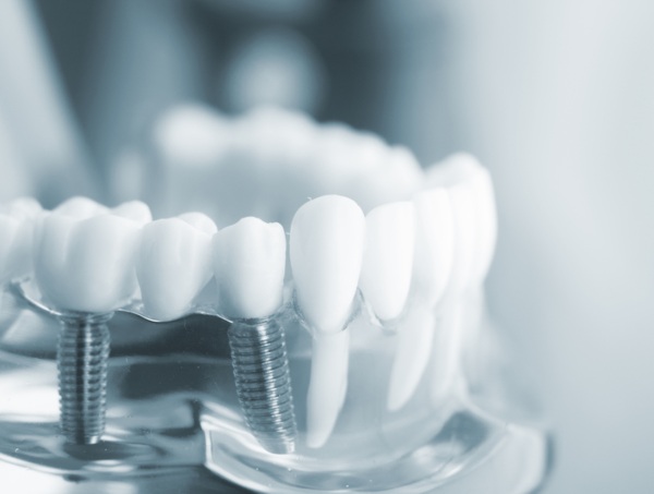 Nha Khoa Quốc Tế Sài Gòn Trồng Implant được thực hiện với bệnh nhân từ 18 tuổi trở lên
