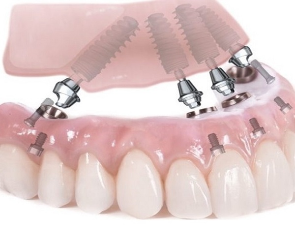 Nha Khoa Quốc Tế Sài Gòn Hàm tháo lắp trên Implant phổ biến với người mất răng nhiều