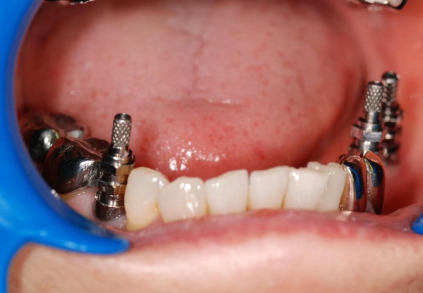 Nha Khoa Quốc Tế Sài Gòn Lấy dấu khay cho trụ Implant đã tích hợp