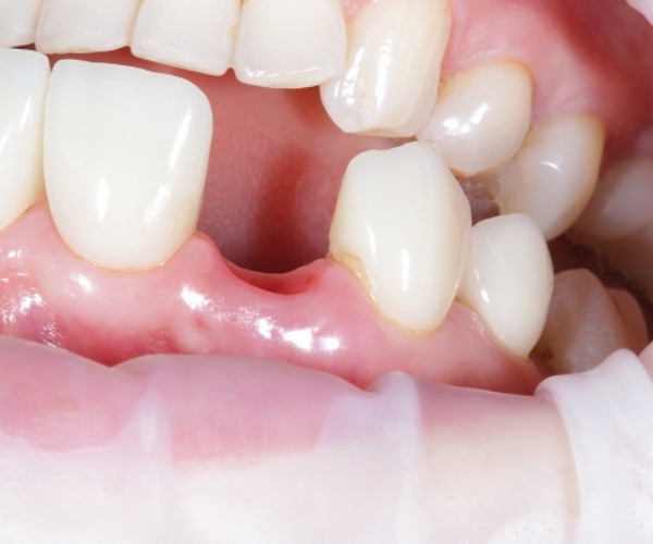 Nha Khoa Quốc Tế Sài Gòn Răng đã nhổ cần thực hiện cấy ghép Implant