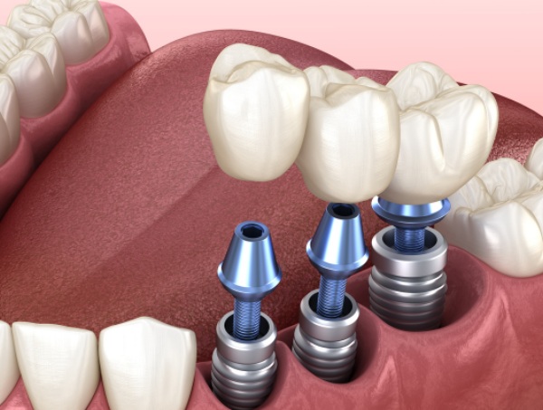 Nha Khoa Quốc Tế Sài Gòn Trồng răng Implant khi còn quá sớm tiềm ẩn nhiều rủi ro
