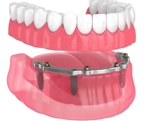 Nha Khoa Quốc Tế Sài Gòn Tháo lắp hàm trên Implant gắn 4 trụ Implant lên thanh bar