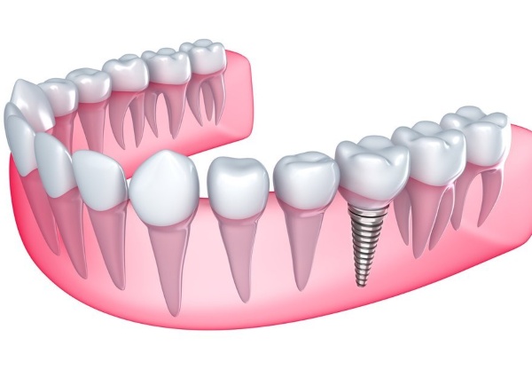Nha Khoa Quốc Tế Sài Gòn Tiến hành Trồng Implant tức thì sau khi nhổ răng
