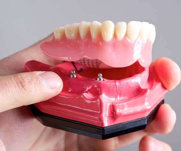 Nha Khoa Quốc Tế Sài Gòn Loại hàm tháo lắp trên Implant không thanh bar