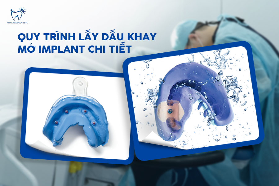 Nha Khoa Quốc Tế Sài Gòn Thực hiện quy trình lấy dấu khay dạng mở Implant