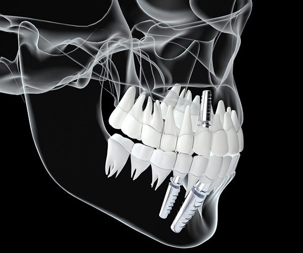 Nha Khoa Quốc Tế Sài Gòn Nên lựa chọn các loại Implant có chứng nhận FDA/CE