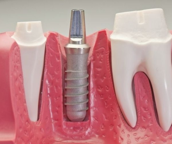 Nha Khoa Quốc Tế Sài Gòn Phương pháp trồng Implant cũng có thể thực hiện sau 1 đến 2 tháng