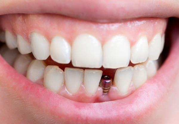 Nha Khoa Quốc Tế Sài Gòn Bệnh nhân từng bị viêm nhiễm sẽ thực hiện trồng Implant sau 3 đến 4 tháng